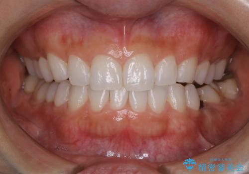 お口の中全体にプラーク(歯垢)が付着している方のクリーニンングの治療後
