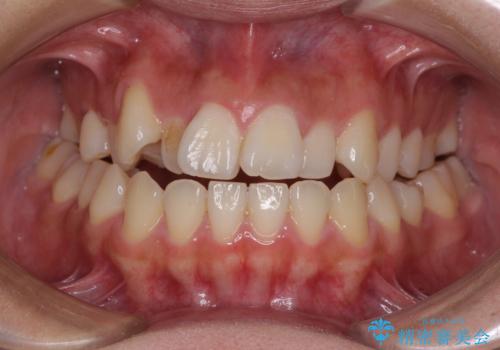 急速拡大装置 狭い上顎骨を拡大してワイヤー装置で短期間治療の治療前