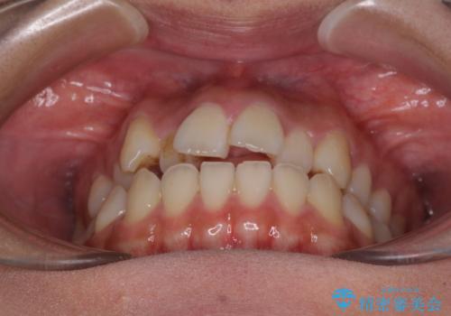 急速拡大装置 狭い上顎骨を拡大してワイヤー装置で短期間治療の治療前