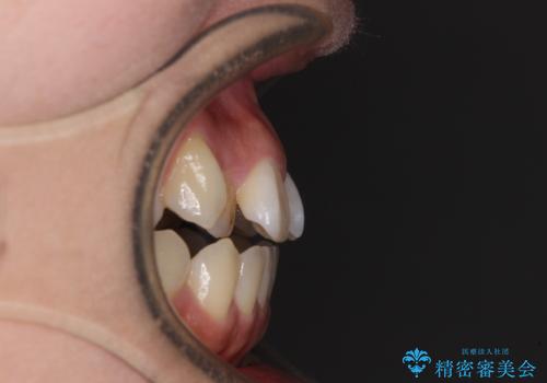 急速拡大装置 狭い上顎骨を拡大してワイヤー装置で短期間治療の治療前