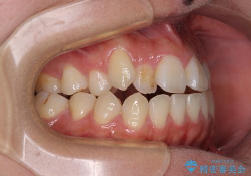 急速拡大装置 狭い上顎骨を拡大してワイヤー装置で短期間治療の治療前