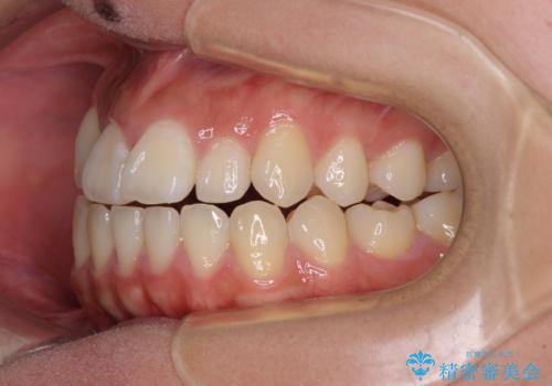 急速拡大装置 狭い上顎骨を拡大してワイヤー装置で短期間治療の治療前