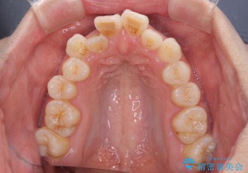 急速拡大装置 狭い上顎骨を拡大してワイヤー装置で短期間治療の治療前