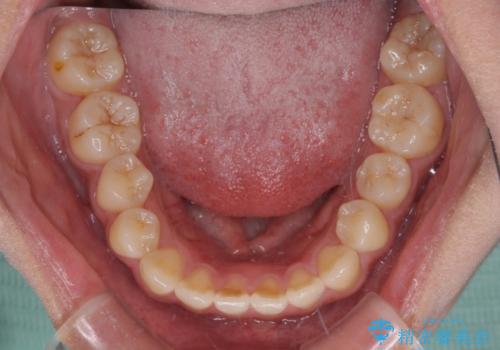 急速拡大装置 狭い上顎骨を拡大してワイヤー装置で短期間治療の治療前