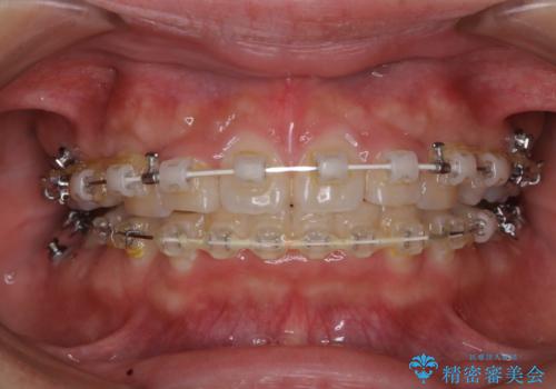 ワイヤー矯正中はたった1ヶ月でとても汚れがたまる