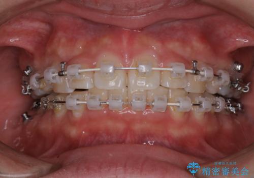 ワイヤー矯正中はたった1ヶ月でとても汚れがたまるの治療後