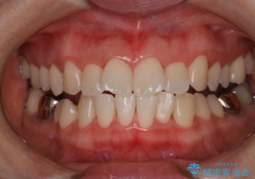 クリーニングにより黄ばみがとれたの治療後