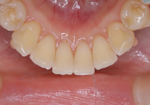 インビザライン矯正中のクリーニングの治療後