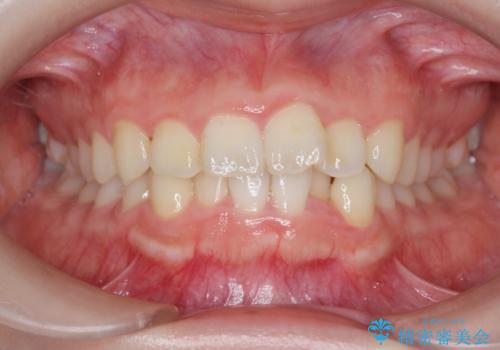 前歯の見た目を改善したいの症例 治療前