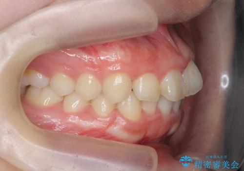 前歯の見た目を改善したいの治療前