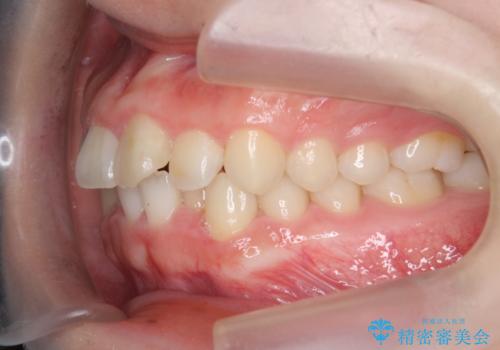 前歯の見た目を改善したいの治療前