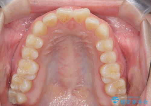 前歯の見た目を改善したいの治療前