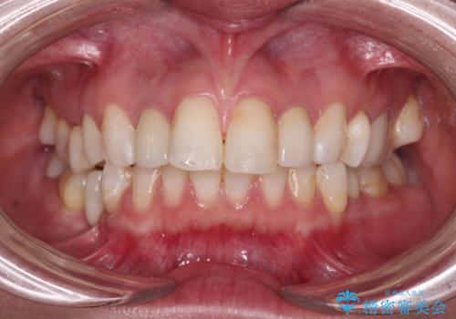 金属の見えてしまったクラウン セラミッククラウンで自然にの治療後