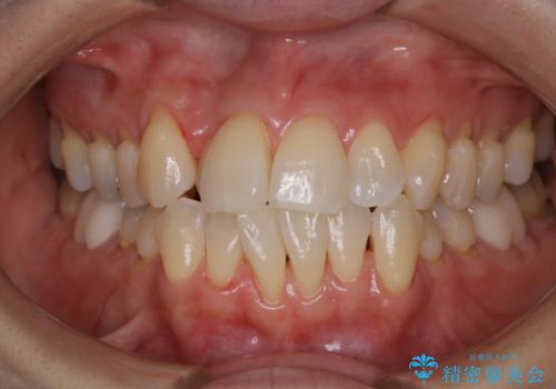 矯正スタート前のクリーニング(PMTC)の症例 治療後