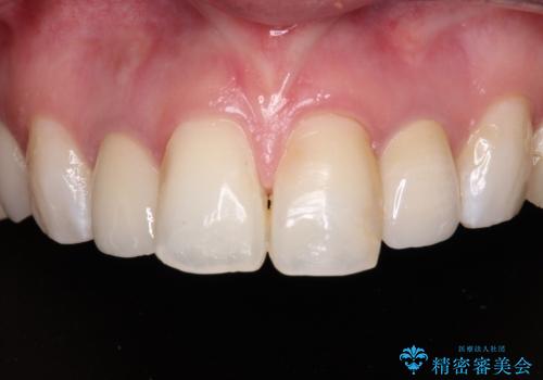 金属の見えてしまったクラウン セラミッククラウンで自然にの症例 治療後