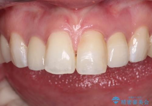金属の見えてしまったクラウン セラミッククラウンで自然にの治療後