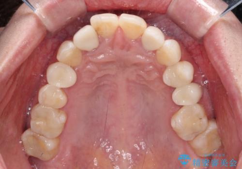 金属の見えてしまったクラウン セラミッククラウンで自然にの治療後