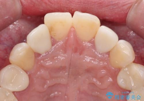 金属の見えてしまったクラウン セラミッククラウンで自然にの治療後