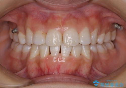 インビザラインのマウスピース発注待ち時、クリーニングおすすめの治療後