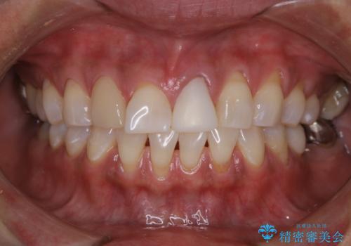 エクセレントコース2回で白い被せ物と同じ色見になった(オフィスホワイトニング)の治療中