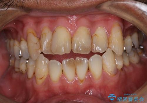 虫歯のチェックはクリーニングをしてから(PMTC)の症例 治療前