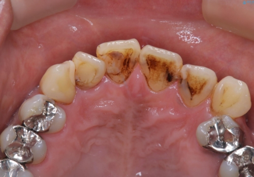 虫歯のチェックはクリーニングをしてから(PMTC)の治療前