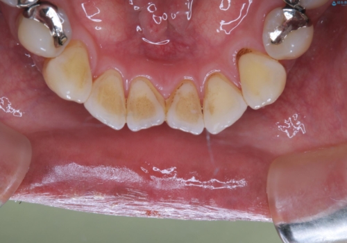 虫歯のチェックはクリーニングをしてから(PMTC)の治療前