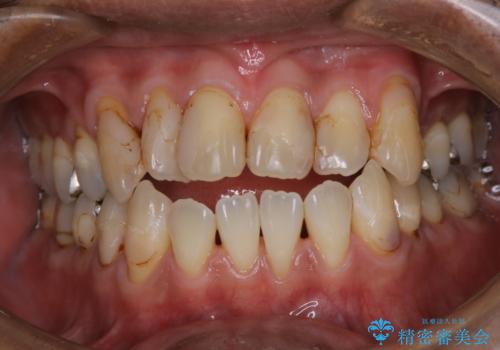 虫歯のチェックはクリーニングをしてから(PMTC)の症例 治療後