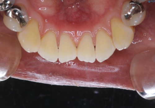 虫歯のチェックはクリーニングをしてから(PMTC)の治療後