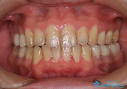 PMTC30分コース(着色、プラーク、歯石、食べかす)の症例 治療前