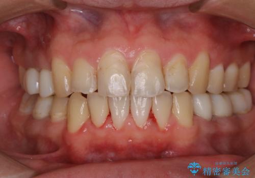 PMTC30分コース(着色、プラーク、歯石、食べかす)の治療後
