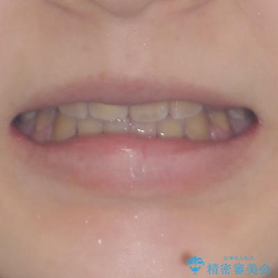 八重歯とクロスバイト　目立たないワイヤー装置での抜歯矯正の治療後（顔貌）