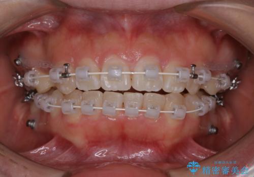 ワイヤーの調整日と一緒にクリーニングをの症例 治療後