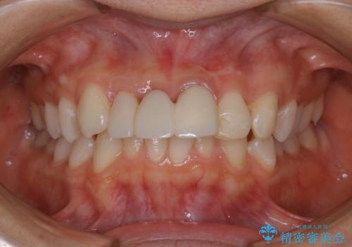 前歯の被せ物に合わせてホワイトニング希望の治療前