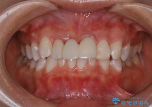 前歯の被せ物に合わせてホワイトニング希望の症例 治療後