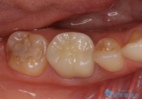 奥歯の歯茎から膿が出る　根管治療とオールセラミッククラウンの症例 治療後