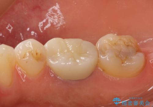 奥歯の歯茎から膿が出る　根管治療とオールセラミッククラウンの治療後