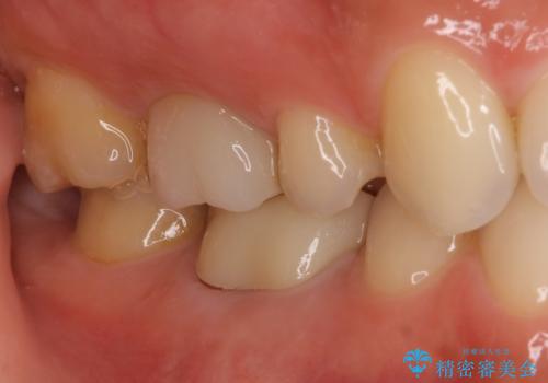 奥歯の歯茎から膿が出る 根管治療とオールセラミッククラウンの治療後