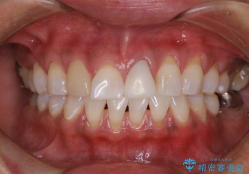 エクセレントコース2回で白い被せ物と同じ色見になった(オフィスホワイトニング)の症例 治療後