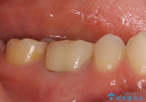 奥歯の歯茎から膿が出る 根管治療とオールセラミッククラウンの治療後