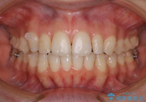 着色落としはPMTCをの治療後