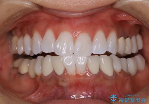 後戻り防止のためのホワイトニング(エクセレントコース)の症例 治療後