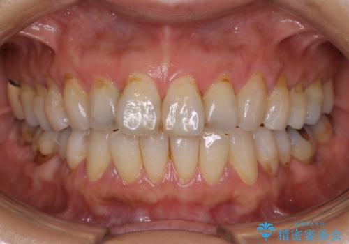 クリーニングで虫歯の進行をストップの症例 治療前