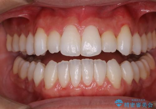 着色落としにはPMTCをの症例 治療後