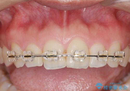 前歯のガタつきをきれいに マウスピース矯正治療の治療前