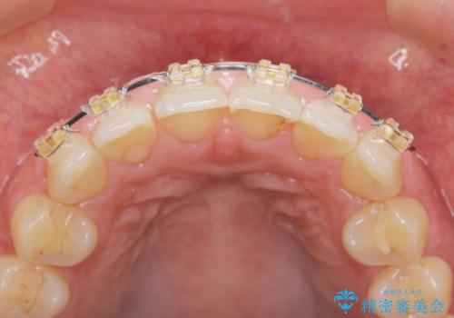 前歯のガタつきをきれいに マウスピース矯正治療の治療前
