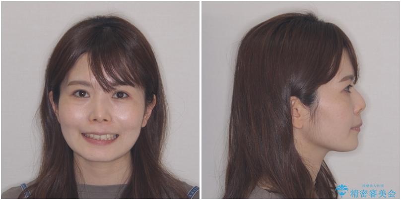 【モニター】口が閉じにくい 目立たないワイヤー装置で口元を引っ込めるの治療後(顔貌)