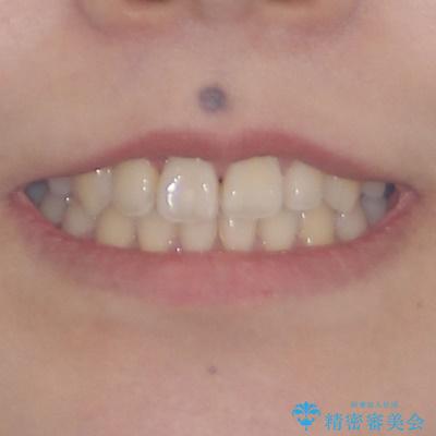 急速拡大装置 狭い上顎骨を拡大してワイヤー装置で短期間治療の治療後(顔貌)