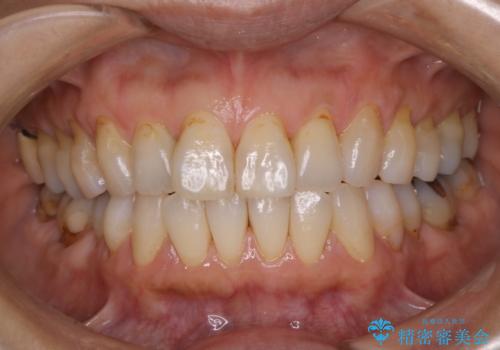クリーニングで虫歯の進行をストップの症例 治療後