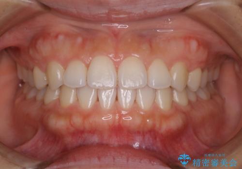 矯正を終えた患者様のクリーニングの症例 治療後